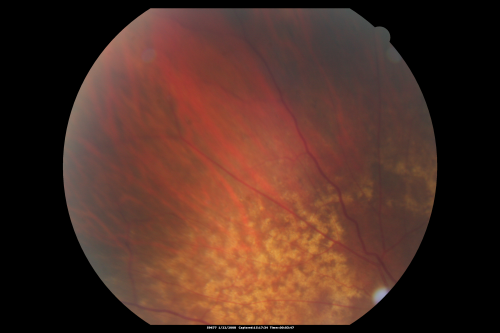 Equatorial Drusen Fundus Photo  Right Eye
