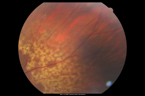 Equatorial Drusen Fundus Photo  Right Eye
