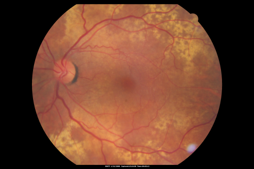 Equatorial Drusen Fundus Photo  Left Eye
