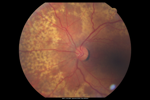 Equatorial Drusen Fundus Photo  Left Eye
