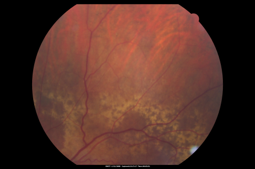 Equatorial Drusen Fundus Photo Left Eye
60-year-old woman OD 20/30, OS 20/20
