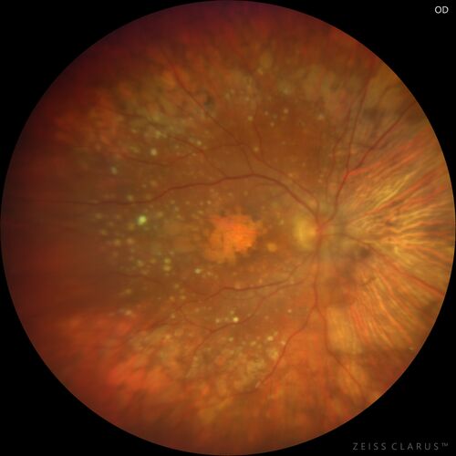 Age-related macular degeneration - Geographic Atrophy - Intermittent CME left eye from CRVO, Anemia, Diabetes
79 year old female - 3 years post CRVO in the left eye (20/32 VA) with intermittent CME.  Left eye is the better eye.  Vision is stable since 2 years ago
PMHx: Type II DM x 20 years, Chronic Anemia, Hyperlipidemia
VA 20/200 OD, 20/50 OS (usually 20/40)
