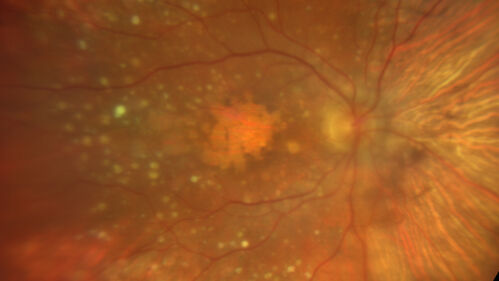 Age-related macular degeneration - Geographic Atrophy - Intermittent CME left eye from CRVO, Anemia, Diabetes
79 year old female - 3 years post CRVO in the left eye (20/32 VA) with intermittent CME.  Left eye is the better eye.  Vision is stable since 2 years ago
PMHx: Type II DM x 20 years, Chronic Anemia, Hyperlipidemia
VA 20/200 OD, 20/50 OS (usually 20/40)
