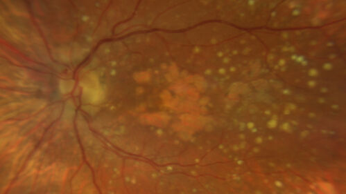 Dry AMD geographic atrophy and cystoid macular edema
79 year old vision is in for a checkup with no visual complaints in the left eye.  This is her better eye.  VA 20/200 OD, 20/50 OS.  3 years ago she had a CRVO in the left eye.  She is also diabetic for 20 years, has carotid insufficiency and anemia.  Left eye shows CME.  This was not treated and the vision improved to 20/40 over the next year although mild edema persisted.
