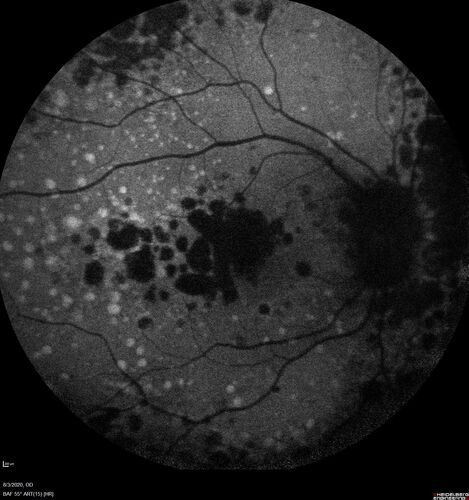Dry AMD geographic atrophy and cystoid macular edema
79 year old vision is in for a checkup with no visual complaints in the left eye.  This is her better eye.  VA 20/200 OD, 20/50 OS.  3 years ago she had a CRVO in the left eye.  She is also diabetic for 20 years, has carotid insufficiency and anemia.  Left eye shows CME.  This was not treated and the vision improved to 20/40 over the next year although mild edema persisted.
