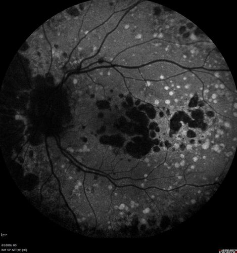 Dry AMD geographic atrophy and cystoid macular edema
79 year old vision is in for a checkup with no visual complaints in the left eye.  This is her better eye.  VA 20/200 OD, 20/50 OS.  3 years ago she had a CRVO in the left eye.  She is also diabetic for 20 years, has carotid insufficiency and anemia.  Left eye shows CME.  This was not treated and the vision improved to 20/40 over the next year although mild edema persisted.
