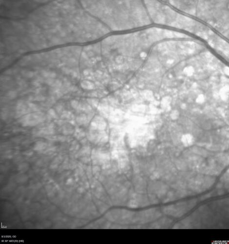 Dry AMD geographic atrophy and cystoid macular edema
79 year old vision is in for a checkup with no visual complaints in the left eye.  This is her better eye.  VA 20/200 OD, 20/50 OS.  3 years ago she had a CRVO in the left eye.  She is also diabetic for 20 years, has carotid insufficiency and anemia.  Left eye shows CME.  This was not treated and the vision improved to 20/40 over the next year although mild edema persisted.
