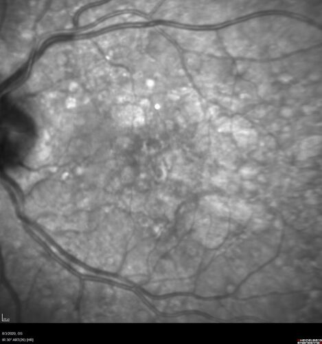 Dry AMD geographic atrophy and cystoid macular edema
79 year old vision is in for a checkup with no visual complaints in the left eye.  This is her better eye.  VA 20/200 OD, 20/50 OS.  3 years ago she had a CRVO in the left eye.  She is also diabetic for 20 years, has carotid insufficiency and anemia.  Left eye shows CME.  This was not treated and the vision improved to 20/40 over the next year although mild edema persisted.
