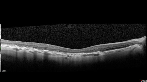 Age-related macular degeneration - Geographic Atrophy - Intermittent CME left eye from CRVO, Anemia, Diabetes
79 year old female - 3 years post CRVO in the left eye (20/32 VA) with intermittent CME.  Left eye is the better eye.  Vision is stable since 2 years ago
PMHx: Type II DM x 20 years, Chronic Anemia, Hyperlipidemia
VA 20/200 OD, 20/50 OS (usually 20/40)
