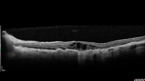 Dry AMD geographic atrophy and cystoid macular edema
79 year old vision is in for a checkup with no visual complaints in the left eye.  This is her better eye.  VA 20/200 OD, 20/50 OS.  3 years ago she had a CRVO in the left eye.  She is also diabetic for 20 years, has carotid insufficiency and anemia.  Left eye shows CME.  This was not treated and the vision improved to 20/40 over the next year although mild edema persisted.
