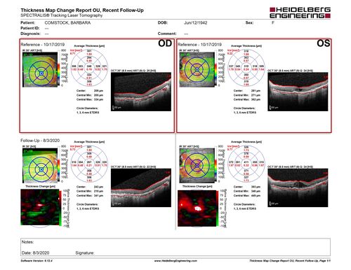 Age-related macular degeneration - Geographic Atrophy - Intermittent CME left eye from CRVO, Anemia, Diabetes
79 year old female - 3 years post CRVO in the left eye (20/32 VA) with intermittent CME.  Left eye is the better eye.  Vision is stable since 2 years ago
PMHx: Type II DM x 20 years, Chronic Anemia, Hyperlipidemia
VA 20/200 OD, 20/50 OS (usually 20/40)
