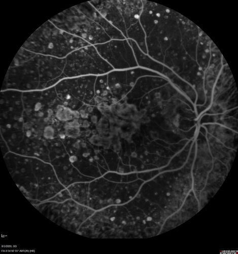 Dry AMD geographic atrophy and cystoid macular edema
79 year old vision is in for a checkup with no visual complaints in the left eye.  This is her better eye.  VA 20/200 OD, 20/50 OS.  3 years ago she had a CRVO in the left eye.  She is also diabetic for 20 years, has carotid insufficiency and anemia.  Left eye shows CME.  This was not treated and the vision improved to 20/40 over the next year although mild edema persisted.
