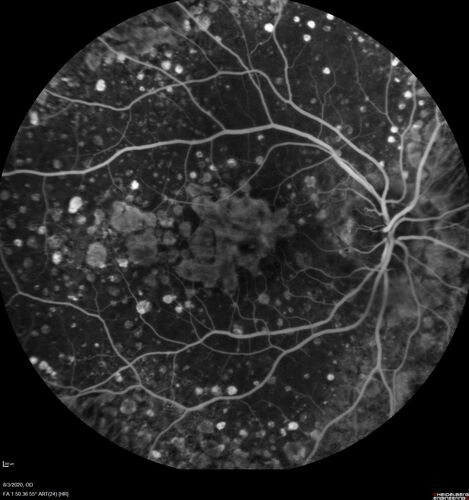 Dry AMD geographic atrophy and cystoid macular edema
79 year old vision is in for a checkup with no visual complaints in the left eye.  This is her better eye.  VA 20/200 OD, 20/50 OS.  3 years ago she had a CRVO in the left eye.  She is also diabetic for 20 years, has carotid insufficiency and anemia.  Left eye shows CME.  This was not treated and the vision improved to 20/40 over the next year although mild edema persisted.
