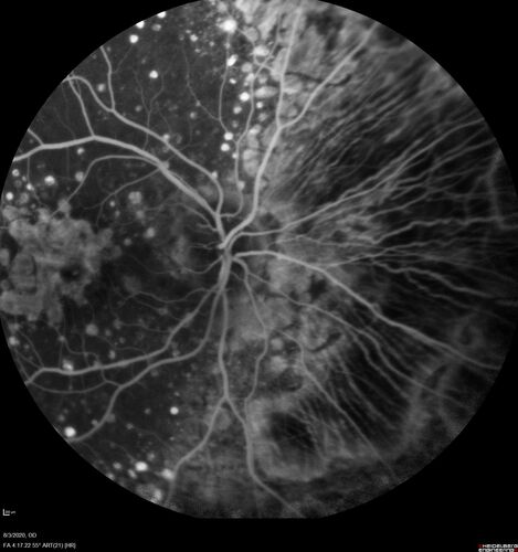 Age-related macular degeneration - Geographic Atrophy - Intermittent CME left eye from CRVO, Anemia, Diabetes
79 year old female - 3 years post CRVO in the left eye (20/32 VA) with intermittent CME.  Left eye is the better eye.  Vision is stable since 2 years ago
PMHx: Type II DM x 20 years, Chronic Anemia, Hyperlipidemia
VA 20/200 OD, 20/50 OS (usually 20/40)

