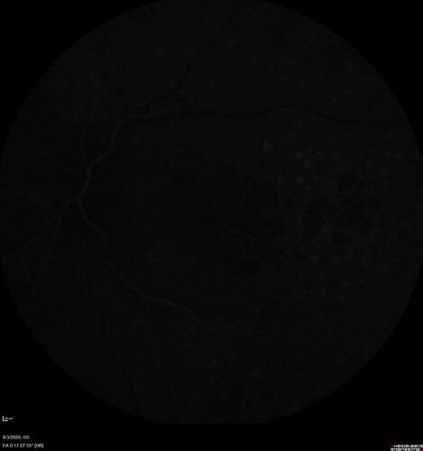 Age-related macular degeneration - Geographic Atrophy - Intermittent CME left eye from CRVO, Anemia, Diabetes
79 year old female - 3 years post CRVO in the left eye (20/32 VA) with intermittent CME.  Left eye is the better eye.  Vision is stable since 2 years ago
PMHx: Type II DM x 20 years, Chronic Anemia, Hyperlipidemia
VA 20/200 OD, 20/50 OS (usually 20/40)
