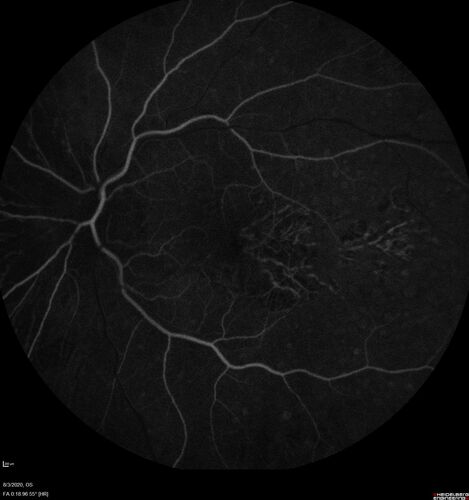 Dry AMD geographic atrophy and cystoid macular edema
79 year old vision is in for a checkup with no visual complaints in the left eye.  This is her better eye.  VA 20/200 OD, 20/50 OS.  3 years ago she had a CRVO in the left eye.  She is also diabetic for 20 years, has carotid insufficiency and anemia.  Left eye shows CME.  This was not treated and the vision improved to 20/40 over the next year although mild edema persisted.

