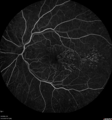 Dry AMD geographic atrophy and cystoid macular edema
79 year old vision is in for a checkup with no visual complaints in the left eye.  This is her better eye.  VA 20/200 OD, 20/50 OS.  3 years ago she had a CRVO in the left eye.  She is also diabetic for 20 years, has carotid insufficiency and anemia.  Left eye shows CME.  This was not treated and the vision improved to 20/40 over the next year although mild edema persisted.
