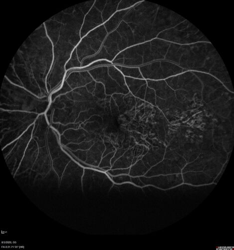 Age-related macular degeneration - Geographic Atrophy - Intermittent CME left eye from CRVO, Anemia, Diabetes
79 year old female - 3 years post CRVO in the left eye (20/32 VA) with intermittent CME.  Left eye is the better eye.  Vision is stable since 2 years ago
PMHx: Type II DM x 20 years, Chronic Anemia, Hyperlipidemia
VA 20/200 OD, 20/50 OS (usually 20/40)
