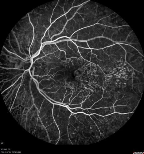 Dry AMD geographic atrophy and cystoid macular edema
79 year old vision is in for a checkup with no visual complaints in the left eye.  This is her better eye.  VA 20/200 OD, 20/50 OS.  3 years ago she had a CRVO in the left eye.  She is also diabetic for 20 years, has carotid insufficiency and anemia.  Left eye shows CME.  This was not treated and the vision improved to 20/40 over the next year although mild edema persisted.
