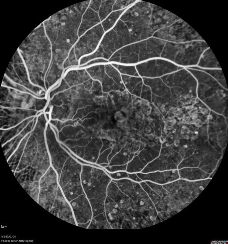 Dry AMD geographic atrophy and cystoid macular edema
79 year old vision is in for a checkup with no visual complaints in the left eye.  This is her better eye.  VA 20/200 OD, 20/50 OS.  3 years ago she had a CRVO in the left eye.  She is also diabetic for 20 years, has carotid insufficiency and anemia.  Left eye shows CME.  This was not treated and the vision improved to 20/40 over the next year although mild edema persisted.
