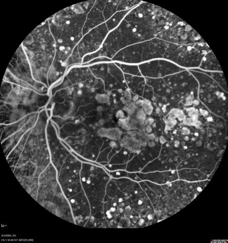 Dry AMD geographic atrophy and cystoid macular edema
79 year old vision is in for a checkup with no visual complaints in the left eye.  This is her better eye.  VA 20/200 OD, 20/50 OS.  3 years ago she had a CRVO in the left eye.  She is also diabetic for 20 years, has carotid insufficiency and anemia.  Left eye shows CME.  This was not treated and the vision improved to 20/40 over the next year although mild edema persisted.
