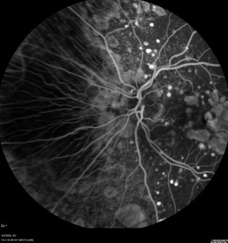 Dry AMD geographic atrophy and cystoid macular edema
79 year old vision is in for a checkup with no visual complaints in the left eye.  This is her better eye.  VA 20/200 OD, 20/50 OS.  3 years ago she had a CRVO in the left eye.  She is also diabetic for 20 years, has carotid insufficiency and anemia.  Left eye shows CME.  This was not treated and the vision improved to 20/40 over the next year although mild edema persisted.
