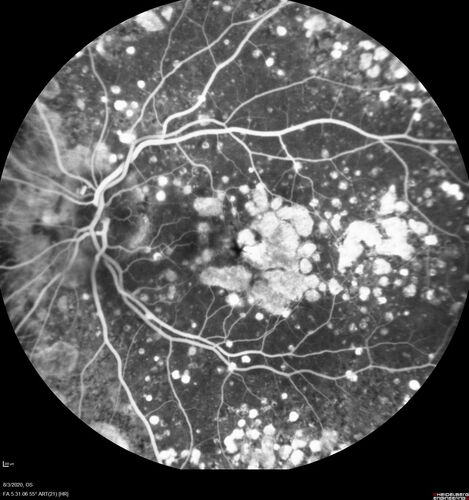 Age-related macular degeneration - Geographic Atrophy - Intermittent CME left eye from CRVO, Anemia, Diabetes
79 year old female - 3 years post CRVO in the left eye (20/32 VA) with intermittent CME.  Left eye is the better eye.  Vision is stable since 2 years ago
PMHx: Type II DM x 20 years, Chronic Anemia, Hyperlipidemia
VA 20/200 OD, 20/50 OS (usually 20/40)
