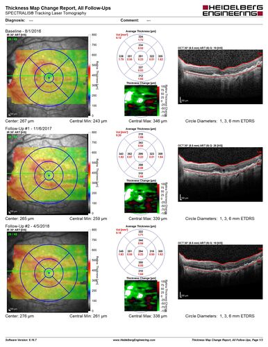 Age-related macular degeneration - Geographic Atrophy - Intermittent CME left eye from CRVO, Anemia, Diabetes
79 year old female - 3 years post CRVO in the left eye (20/32 VA) with intermittent CME.  Left eye is the better eye.  Vision is stable since 2 years ago
PMHx: Type II DM x 20 years, Chronic Anemia, Hyperlipidemia
VA 20/200 OD, 20/50 OS (usually 20/40)
