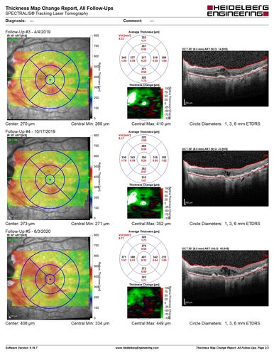 Dry AMD geographic atrophy and cystoid macular edema
79 year old vision is in for a checkup with no visual complaints in the left eye.  This is her better eye.  VA 20/200 OD, 20/50 OS.  3 years ago she had a CRVO in the left eye.  She is also diabetic for 20 years, has carotid insufficiency and anemia.  Left eye shows CME.  This was not treated and the vision improved to 20/40 over the next year although mild edema persisted.
