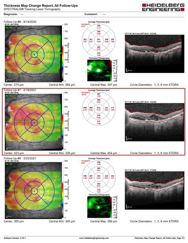 Age-related macular degeneration - Geographic Atrophy - Intermittent CME left eye from CRVO, Anemia, Diabetes
79 year old female - 3 years post CRVO in the left eye (20/32 VA) with intermittent CME.  Left eye is the better eye.  Vision is stable since 2 years ago
PMHx: Type II DM x 20 years, Chronic Anemia, Hyperlipidemia
VA 20/200 OD, 20/50 OS (usually 20/40)
