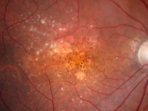Non-Foveal Geographic Atrophy Both Eyes
81-year-old man has age-related macular degeneration in both eyes.  Vision OD is 20/40, OS is 20/80.
