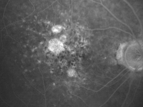 Non-Foveal Geographic Atrophy Both Eyes
81-year-old man has age-related macular degeneration in both eyes.  Vision OD is 20/40, OS is 20/80.
