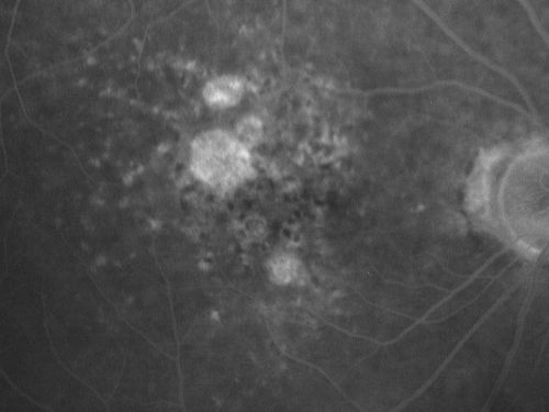 Non-Foveal Geographic Atrophy Both Eyes
81-year-old man has age-related macular degeneration in both eyes.  Vision OD is 20/40, OS is 20/80.
