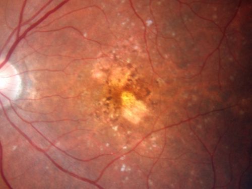 Non-Foveal Geographic Atrophy Both Eyes
81-year-old man has age-related macular degeneration in both eyes.  Vision OD is 20/40, OS is 20/80.
