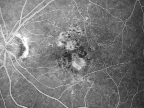Non-Foveal Geographic Atrophy Both Eyes
81-year-old man has age-related macular degeneration in both eyes.  Vision OD is 20/40, OS is 20/80.
