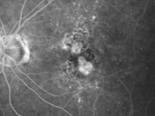 Non-Foveal Geographic Atrophy Both Eyes
81-year-old man has age-related macular degeneration in both eyes.  Vision OD is 20/40, OS is 20/80.
