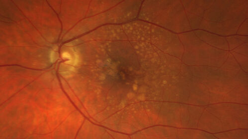Dry AMD - Pigment - AREDS risk score of 4
65 year old woman with 20/32 vision.  A little blurred.  Pigment and large drusen in each eye.  AREDS risk score of four.
