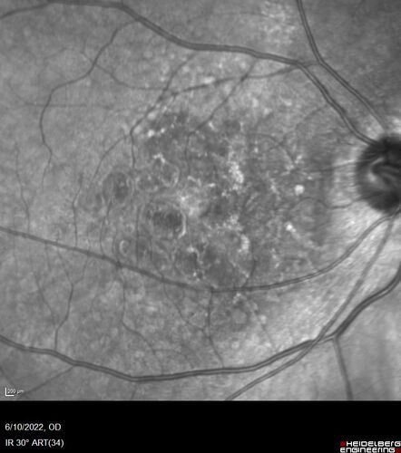 Dry AMD - Pigment - AREDS risk score of 4
65 year old woman with 20/32 vision.  A little blurred.  Pigment and large drusen in each eye.  AREDS risk score of four.

