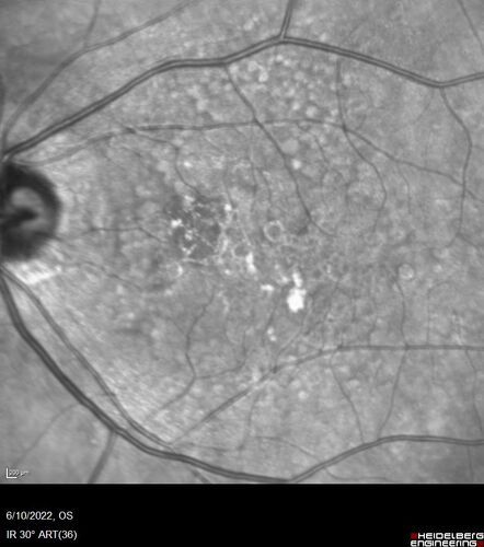 Dry AMD - Pigment - AREDS risk score of 4
65 year old woman with 20/32 vision.  A little blurred.  Pigment and large drusen in each eye.  AREDS risk score of four.
