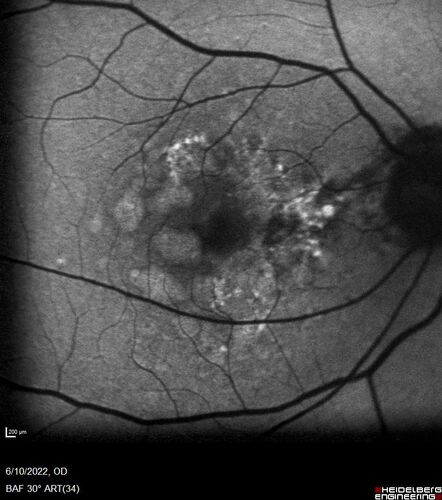 Dry AMD - Pigment - AREDS risk score of 4
65 year old woman with 20/32 vision.  A little blurred.  Pigment and large drusen in each eye.  AREDS risk score of four.
