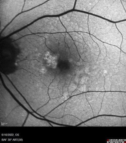 Dry AMD - Pigment - AREDS risk score of 4
65 year old woman with 20/32 vision.  A little blurred.  Pigment and large drusen in each eye.  AREDS risk score of four.
