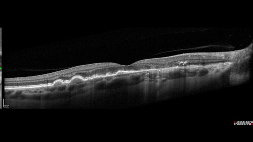 Dry AMD - Pigment - AREDS risk score of 4
65 year old woman with 20/32 vision.  A little blurred.  Pigment and large drusen in each eye.  AREDS risk score of four.
