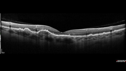 Dry AMD - Pigment - AREDS risk score of 4
65 year old woman with 20/32 vision.  A little blurred.  Pigment and large drusen in each eye.  AREDS risk score of four.
