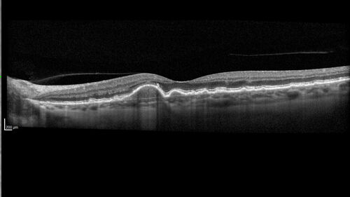 Dry AMD - Pigment - AREDS risk score of 4
65 year old woman with 20/32 vision.  A little blurred.  Pigment and large drusen in each eye.  AREDS risk score of four.
