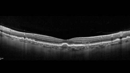 Dry AMD - Pigment - AREDS risk score of 4
65 year old woman with 20/32 vision.  A little blurred.  Pigment and large drusen in each eye.  AREDS risk score of four.

