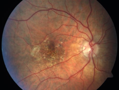 Hyperpigmentation of Retinal Pigment Epithlium in Dry AMD (hyperplasia)
87-year-old woman has wet age-related macular degeneration in the left eye.  She had treatment up north but there has been a gap in therapy and the vision in the left eye is poor.  Vision OD is 20/25, OS is 20/400
