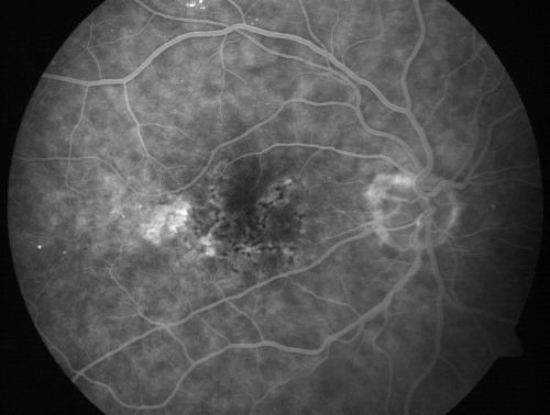 Hyperpigmentation of Retinal Pigment Epithlium in Dry AMD (hyperplasia)
87-year-old woman has wet age-related macular degeneration in the left eye.  She had treatment up north but there has been a gap in therapy and the vision in the left eye is poor.  Vision OD is 20/25, OS is 20/400
