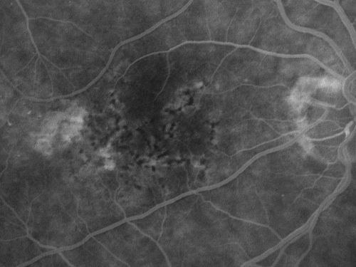 Hyperpigmentation of Retinal Pigment Epithlium in Dry AMD (hyperplasia)
87-year-old woman has wet age-related macular degeneration in the left eye.  She had treatment up north but there has been a gap in therapy and the vision in the left eye is poor.  Vision OD is 20/25, OS is 20/400

