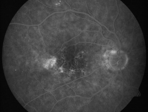 Hyperpigmentation of the Retinal Pigment Epithelium in Dry AMD
87-year-old woman has wet age-related macular degeneration in the left eye.    Vision OD is 20/25, OS is 20/400
