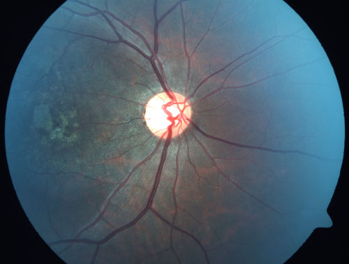 Macular possible Cone Dystrophy
